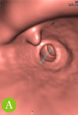 大腸CTC検査画像１