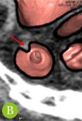 大腸CTC検査画像2