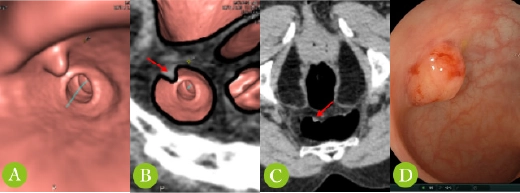 大腸3D‐CT検査画像